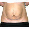 Abdominoplasty 25 Before Photo Thumbnail