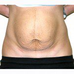 Abdominoplasty 25 Before Photo - 3