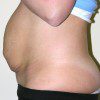 Abdominoplasty 25 Before Photo Thumbnail