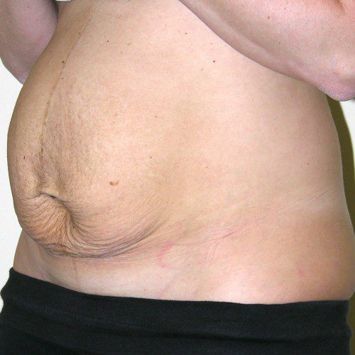 Abdominoplasty 25 Before Photo