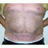 Abdominoplasty 26 After Photo Thumbnail