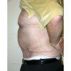 Abdominoplasty 26 After Photo Thumbnail