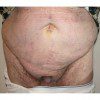 Abdominoplasty 26 Before Photo Thumbnail