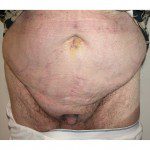 Abdominoplasty 26 Before Photo - 2
