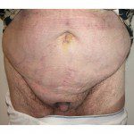 Abdominoplasty 26 Before Photo - 3