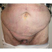 Abdominoplasty 26