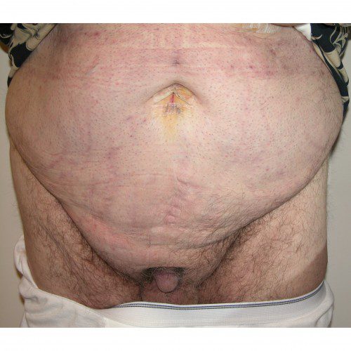 Abdominoplasty 26 Before Photo 