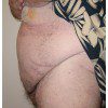 Abdominoplasty 26 Before Photo Thumbnail