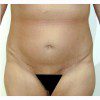 Abdominoplasty 27 After Photo Thumbnail