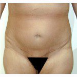 Abdominoplasty 27 After Photo - 2