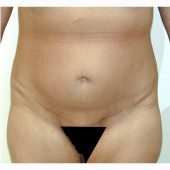 Abdominoplasty 27