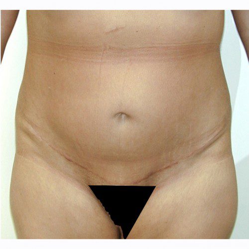 Abdominoplasty 27 After Photo 