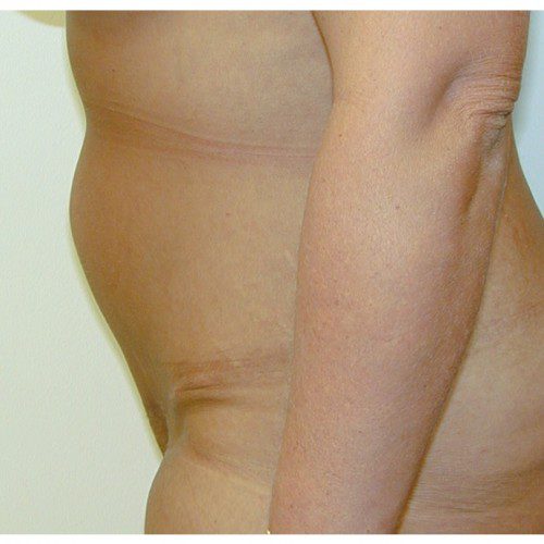 Abdominoplasty 27 After Photo