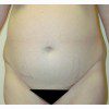 Abdominoplasty 27 Before Photo Thumbnail