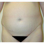 Abdominoplasty 27 Before Photo - 1