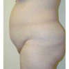 Abdominoplasty 27 Before Photo Thumbnail