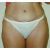 Abdominoplasty 7 After Photo Thumbnail