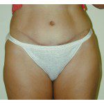 Abdominoplasty 7 After Photo - 10