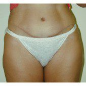 Abdominoplasty 7
