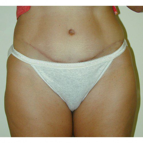 Abdominoplasty 7 After Photo 