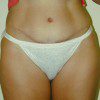 Abdominoplasty 38 After Photo Thumbnail