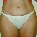 Abdominoplasty 38 After Photo - 1