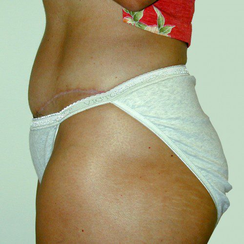 Abdominoplasty 7 After Photo