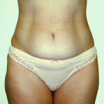 Abdominoplasty 7 Before Photo - 10