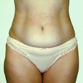 Abdominoplasty 7