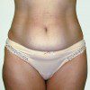 Abdominoplasty 38 Before Photo Thumbnail