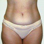 Abdominoplasty 38 Before Photo - 2