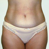 Abdominoplasty 38
