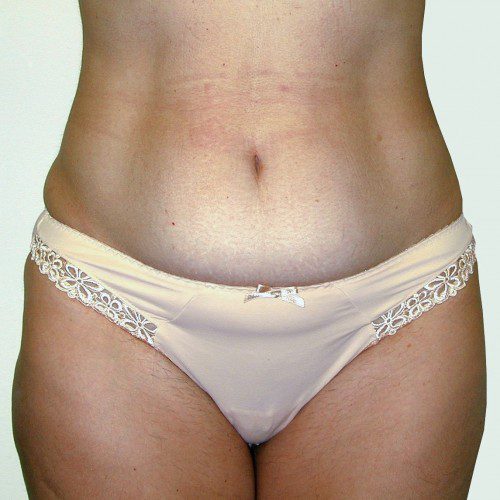 Abdominoplasty 38 Before Photo 