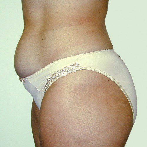 Abdominoplasty 7 Before Photo