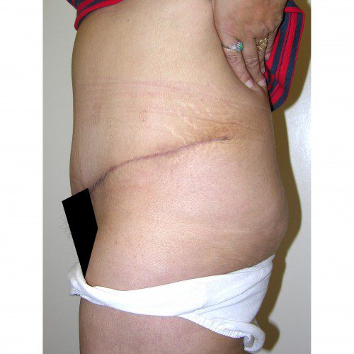 Abdominoplasty 28 After Photo