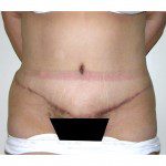 Abdominoplasty 28 After Photo - 1