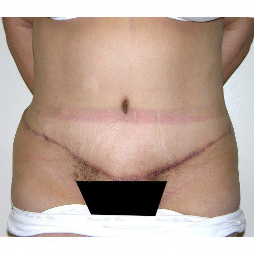 Abdominoplasty 28 After Photo 