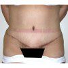 Abdominoplasty 28 After Photo Thumbnail