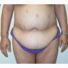 Abdominoplasty 28 Before Photo Thumbnail