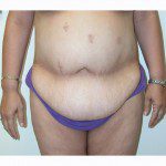 Abdominoplasty 28 Before Photo - 12