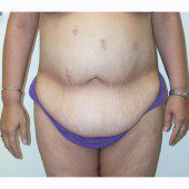 Abdominoplasty 28