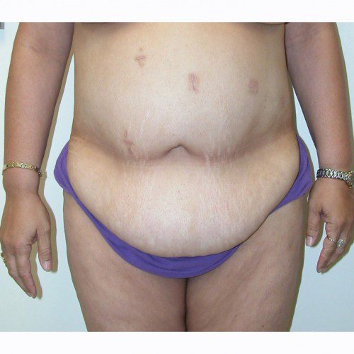 Abdominoplasty 28 Before Photo 