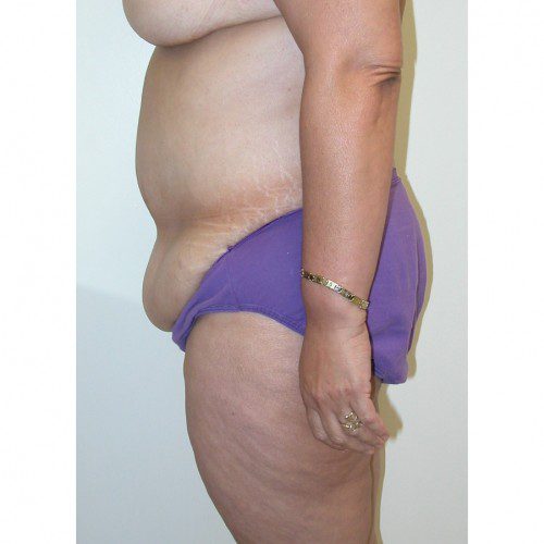 Abdominoplasty 28 Before Photo