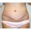 Abdominoplasty 29 After Photo Thumbnail