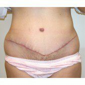 Abdominoplasty 29