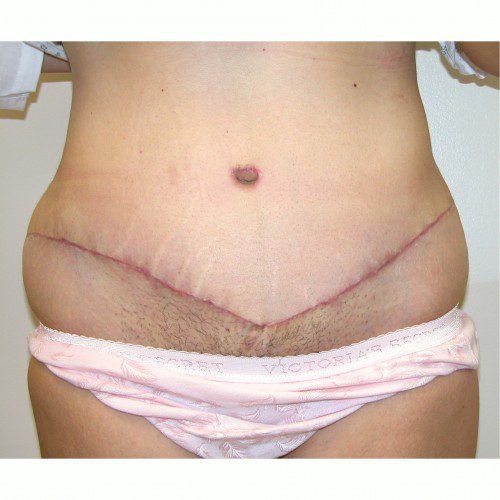 Abdominoplasty 29 After Photo 