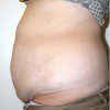 Abdominoplasty 29 Before Photo Thumbnail