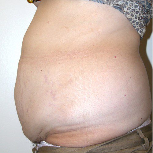 Abdominoplasty 29 Before Photo