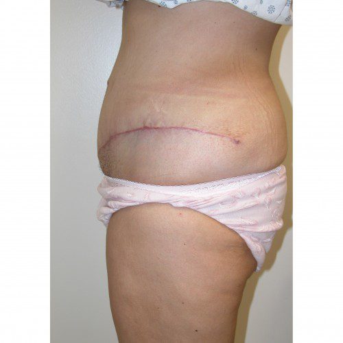 Abdominoplasty 29 After Photo