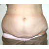 Abdominoplasty 29 Before Photo Thumbnail